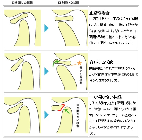 顎関節の音がなる原因について